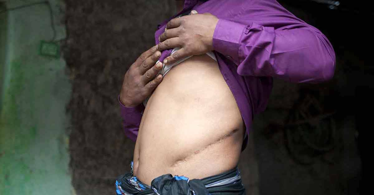In this file photo, Bangladeshi villager Belal Hossian, 35, a victim of illegal organ trade, shows the scars from his illegal kidney removal operation in the village of Kalai some 300 km (185 miles) northwest of Dhaka. (AFP Photo)