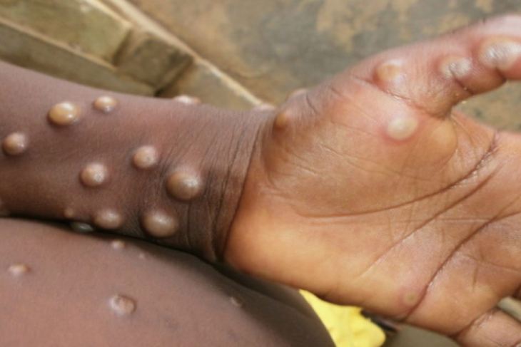 A child with monkeypox